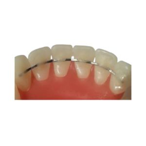 Universal Lingual Retainer